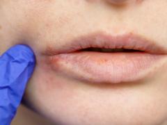 如何防止新冠二次传播